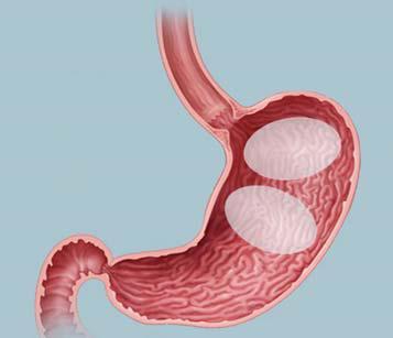 Trattamento dell obesità e del sovrappeso con palloncino intragastrico Obalon Il sistema di palloncini gastrici Obalon è indicato per favorire il calo ponderale riempiendo parzialmente lo stomaco e