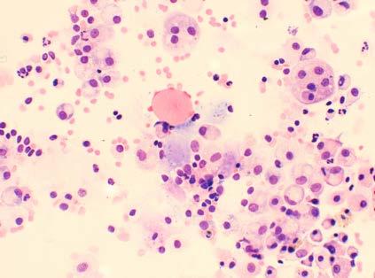 BAL nella Sclerosi Sistemica in patients with SSc, the globules were significantly related to BAL neutrophilia or