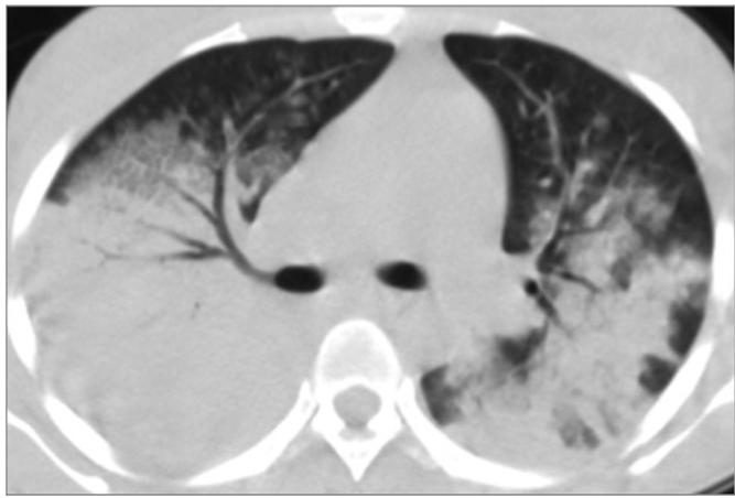 Acute lupus pneumonitis Pattern HRCT di Diffusa emorragia alveolare con quadro clinico