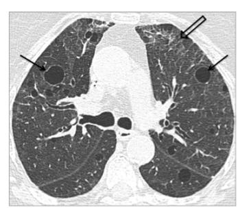 Pneumonia (LIP) Anomalie