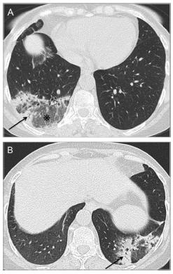 Polimiosite/Dermatomiosite Interessamento polmonare nel 40% dei casi Ab-ingestis, Debolezza muscolatura respiratoria Quadri misti di overlap tra NSIP ed Organizing Pneumonia Consolidamento
