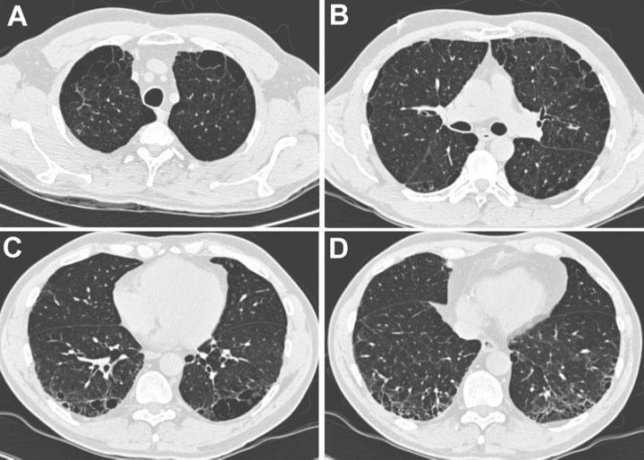 Combined pulmonary fibrosis and emphysema syndrome (CPFE) Entità clinica caratterizzata da Enfisema centrolobulare o parasettale Opacità infiltrative diffuse suggestive di fibrosi predominante nei