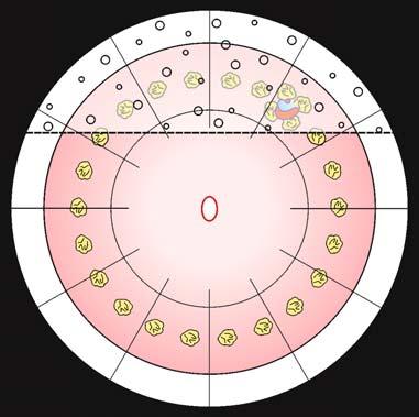 192 9 Trattamento del distacco retinico primario a b Fig. 9.6. Trattamento del distacco in Fig. 9.1. con pneumoretinopessia senza drenaggio, con retinopessia limitata alla rottura (a) o estesa per 360 (b) [25].