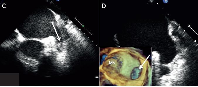 thrombus with