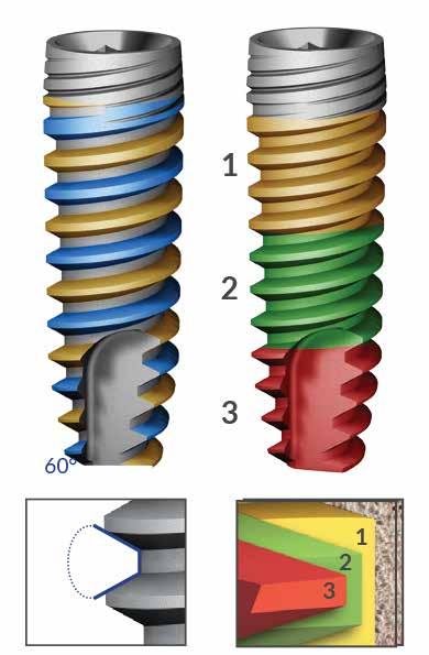 3 mm e apertura 60 Spire continue e profonde SPIRE DELL'IMPIANTO Inserimento facile non aggressivo Penetrazione rapida e controllata dell osso Eccellente grip osseo Capacità autoperforante