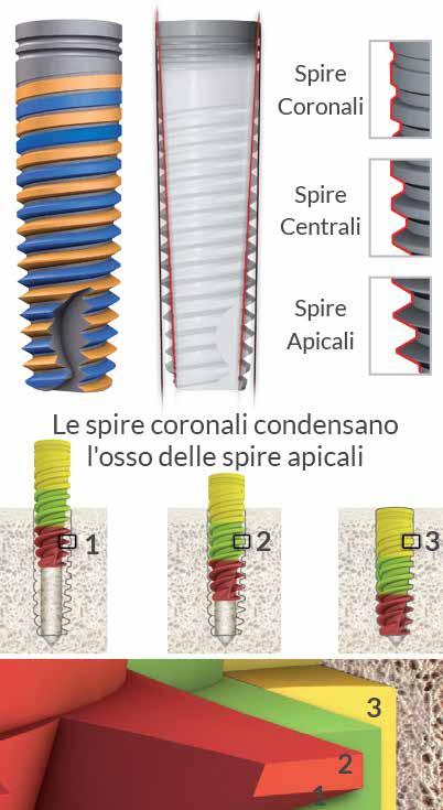 Connessione ad Esagono interno DFI PARTE CORONALE Micro anelli* Bone platform shifting Superficie porosa sino alla testa dell impianto Le spire arrivano sino alla testa dell impianto Superficie di