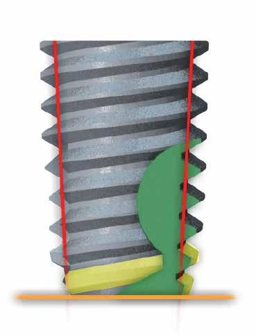 Stabilità primaria Facile inserzione SPIRE DELL'IMPIANTO Doppia filettatura 2 X 1.