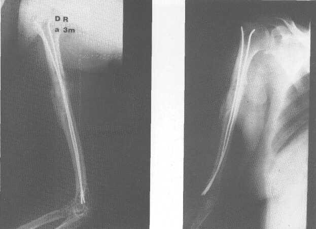 Osteosintesi elastica nelle fratture diafisarie di omero