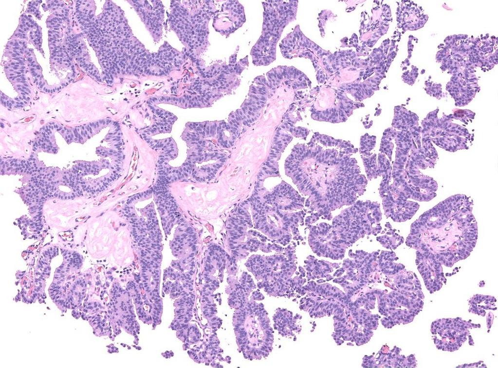 VAB VAB: parenchima fibroadiposo con