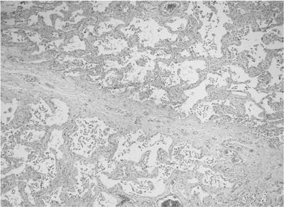 Nonspecific interstitial pneumonia (NSIP) Spatial and temporal homogeneity of the lesions Lack of fibroblastic foci HISTOLOGIC FEATURES OF NONSPECIFIC INTERSTITIAL PNEUMONIA Key Histologic Features