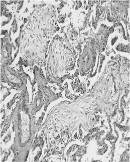 HISTOLOGIC AND CLINICAL CLASSIFICATION OF IDIOPATHIC INTERSTITIAL PNEUMONIAS Clinical-Radiologic-Pathologic Diagnosis Histologic Pattern Idiopathic pulmonary fibrosis Nonspecific interstitial