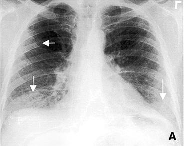 Cryptogenic organizing pneumonia. Chest radiograph shows multifocal consolidation (arrows).