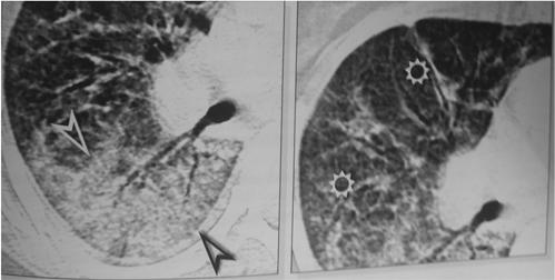 Radiologic features of AIP Chest radiografic features: Bilateral airspace opacification with air bronchograms Typical CT findings: Parenchymal consolidation Ground-glass opacities Reticular pattern