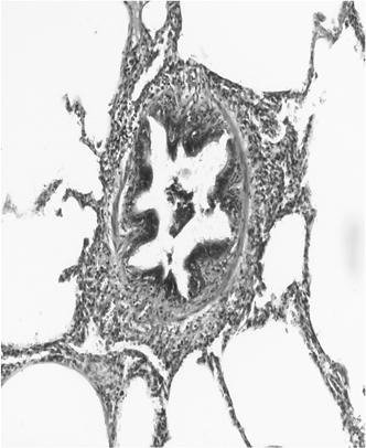 HISTOPATHOLOGIC ELEMENTS OF RB-ILD Multifocal accumulation of pigmented macrophages in the respiratory bronchioles and surrounding alveolar spaces.