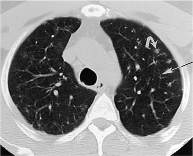 Monaldi Usual radiographic features: Bronchial wall thickening; ground glass opacity Typical CT findings: Bronchial wall thickening Centrilobular nodules