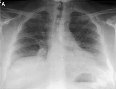 Usual radiographic features: Patchy ground glass opacities Typical CT findings: Ground glass attenuation Reticular lines Moderate distortion of the pulmonary architecture and traction bronchiectasis