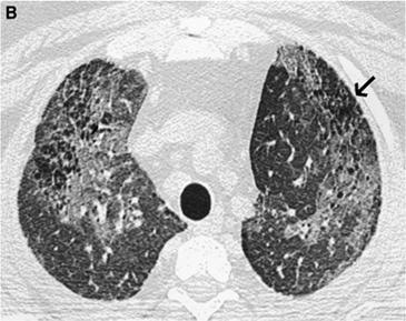 OF IDIOPATHIC INTERSTITIAL PNEUMONIAS Clinical-Radiologic-Pathologic Diagnosis Histologic Pattern Idiopathic pulmonary fibrosis Nonspecific interstitial pneumonia Cryptogenig organizing pneumonia