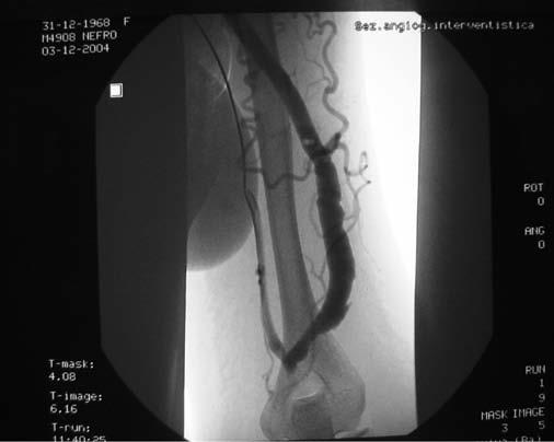 1B - La FAV viene esclusa mediante rilascio di stent coperto posizionato nell arteria brachiale a livello dell anastomosi artero-venosa.