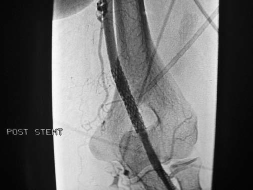 La FAV venne esclusa mediante rilascio di stent-graft (nitinol-ptfe Atrium, Hudson, New, Hampishire, USA) di dimensioni 7x40 mm, posizionato nell arteria brachiale a livello dell anastomosi