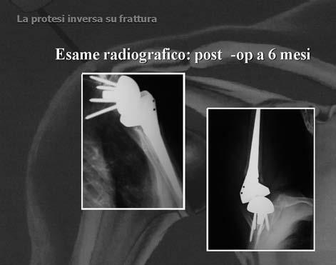 Roentgenographic findings in massive rotator cuff tears. A long-term observation. Clin Orthop Relat Res. 1990;254:92-96. 4. Jerosch J, Muller T, Castro WH. The incidence of rotator cuff rupture.