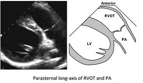 Come visualizzare il ventricolo destro PARASTERNALE
