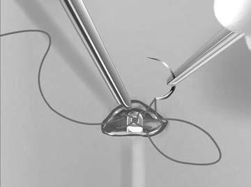 8. Una volta che la punta distale dello strumento EIT emerge dall incisione superiore, scollegare e trattenere il laccio di sutura dalla punta distale dello strumento EIT.