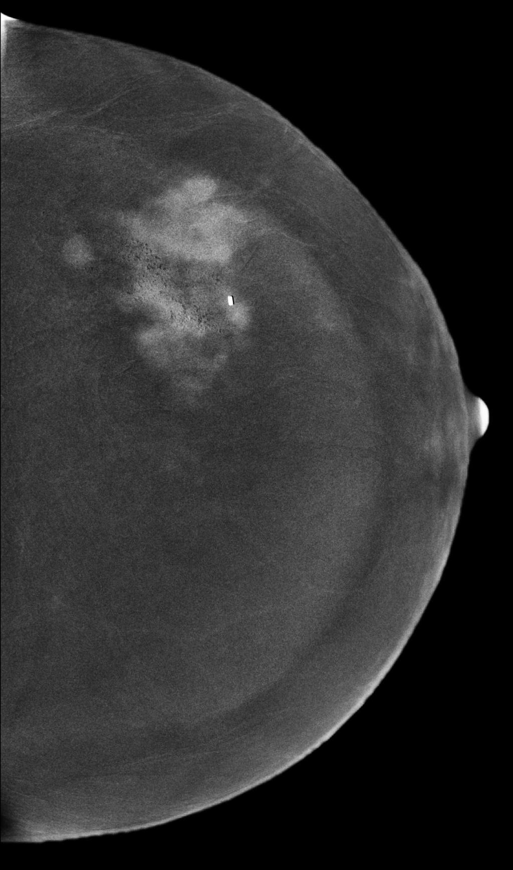 CESM (CONTRAST ENHANCED SPECTRAL MAMMOGRAPHY)