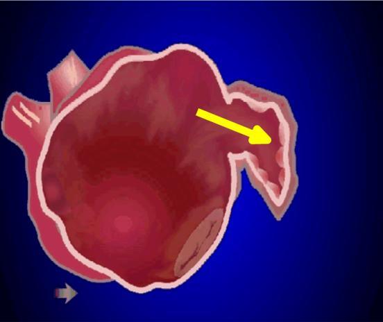 Approccio endocardico Le modalità di chiusura dell auricola sinistra Approccio epicardico Atritech-4 generation