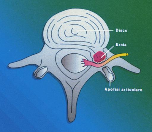 SOSTANZE ALGOGENE LIBERATE DAL NUCLEO POLPOSO PROSTAGLANDINE