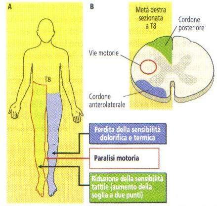 Lesioni midollari Shock spinale: