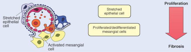 Patogenesi della nefropatia diabetica Il secondo passaggio è lo sviluppo di sclerosi mesangiale: le