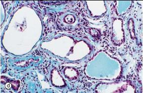 Patogenesi della nefropatia diabetica La fibrosi tubulo interstiziale La severità del