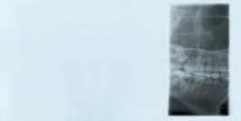 Orthoralix 9200 Opzione DMF programmi speciali di radiologia dento-maxillo-facciale Seni frontali Vista frontale delle articolazioni temporo-mandibolari.
