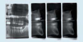 Orthoralix 9200 Opzione implantologica TRANSCAN Transcan Proiezioni realizzate con tecnica tomografica lineare producono tre viste di sezioni trasversali di mascella e mandibola.