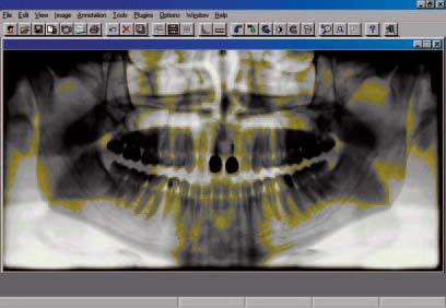 utilizzano la normale pellicola radiografica,