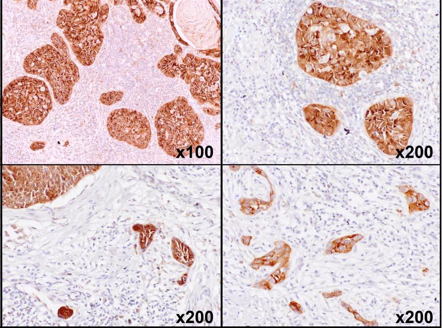 Proliferazione illimitata Tessuto invaso da cellule tumorali (in marrone) In condizioni normali le cellule controllano la produzione e il rilascio dei fahori di crescita che fanno entrare le
