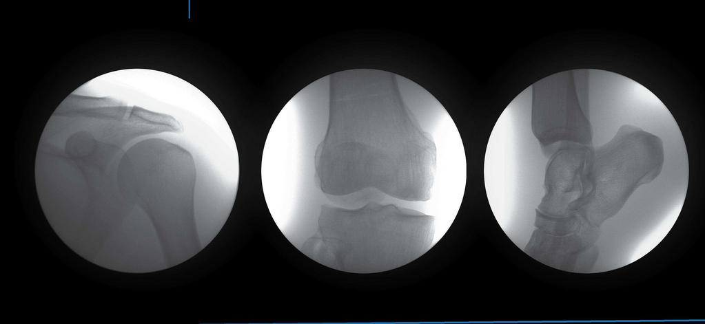 ADJUSTMENT FREE IMAGING OrthoScan HD si setta automaticamente in presenza di metallo, secondo la dinamicità e la densità della parte anatomica in acquisizione.