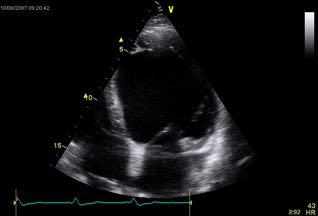 Non LBBB