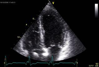 True LBBB Responder