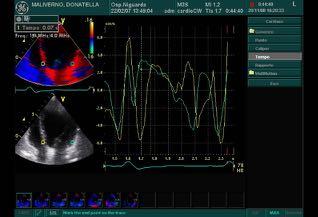 True LBBB