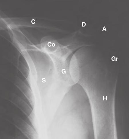 Diaframma Gomito Cistifellea Milza Fig. 8.111 - Strutture anatomiche che possono causare dolore riferito alla spalla.