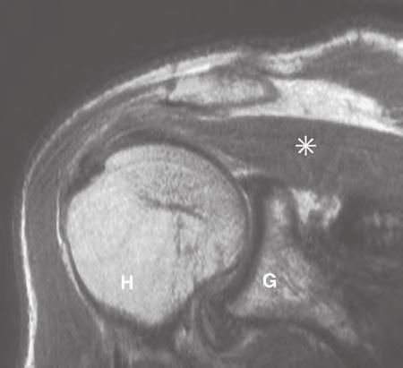 Diagnostica per immagini Le principali immagini radiologiche della spalla sono illustrate nelle figure da 8.112 a 8.114. Fig.