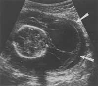 Absence of X chromosome (45, X0) or X monosomy (maternal in 2/3) Mosaicism