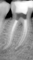 L Informatore Endodontico Vol. 6, Nr. 2 2003 la compattazione corono-apicale, è possibile che la guttaperca si contragga e che il sigillo apicale venga perduto.