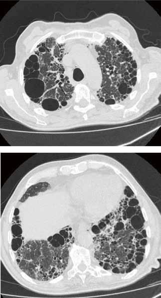 F. Mei et al. nel 2004, e complessivamente, in letteratura, ad oggi, sono stati riportati unicamente 25 casi di PPFE con diagnosi istologica mediante biopsia chirurgica od esame autoptico 2-6.