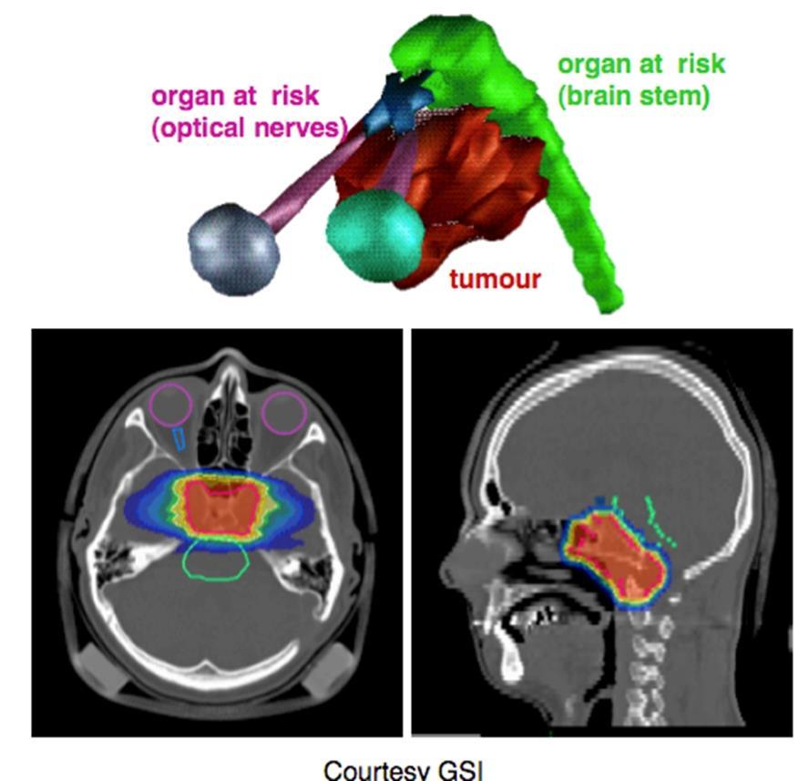 Radioterapia e Adroterapia (Particle Therapy) GOAL Depositare una dose sufficientemente alta nella zona tumorale Allo stesso tempo cercare di salvaguardare i tessuti sani e