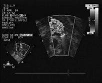 Diagnosi Diagnosi Ecocardiografia-Color-Doppler: 2D 1. Doming dei lembi valvolari 2. Ispessimento dei lembi valvolari 3.