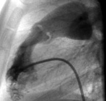 147 pz (età 2 gg- 15 anni) Storia Naturale e Prognosi 1. Stenosi lievi diventate severe 5 % 2. Stenosi moderate diventate severe 61 % D.G. Rowland et al. (Am. J.