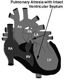 Anatomia Malformazione cardiaca nella quale è assente la continuità VD-AP per atresia: Valvolare Infundibulo-valvolare.