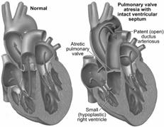 destro Eziologia ed Epidemiologia Fisiopatologia Processo infiammatorio prenatale Fattori Genetici?? Cardiopatia congenita rara 0.